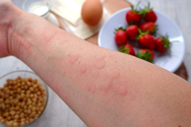 i diversi tipi di intolleranze alimentari e come riconoscerle